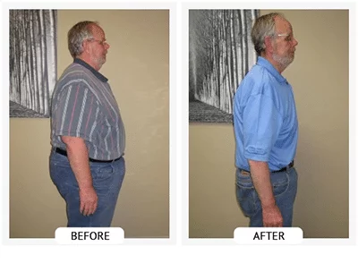 Chiropractic Athens GA ChiroThin Bill